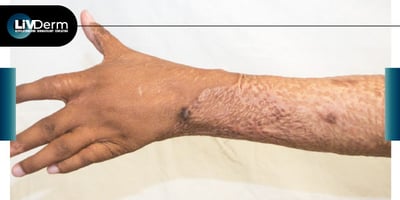 LiVDerm-Newsletter---February-020222-6