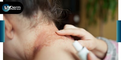 Roflumilast cream safe, effective in mild to moderate atopic dermatitis
