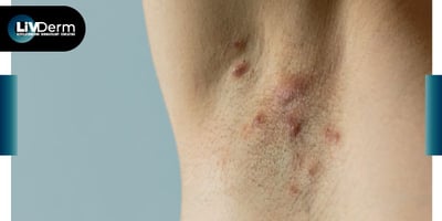 Orismilast achieves positive results in psoriasis, fast track for hidradenitis suppurativa