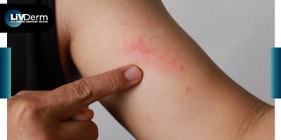 Study Examines Dupilumab Effectiveness in Erythrodermic Atopic Dermatitis