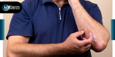 Nonsteroidal Treatment Options for Plaque Psoriasis