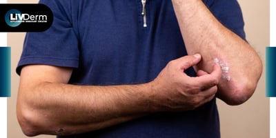 Long-term use of guselkumab in psoriasis treatment does not increase cancer risk